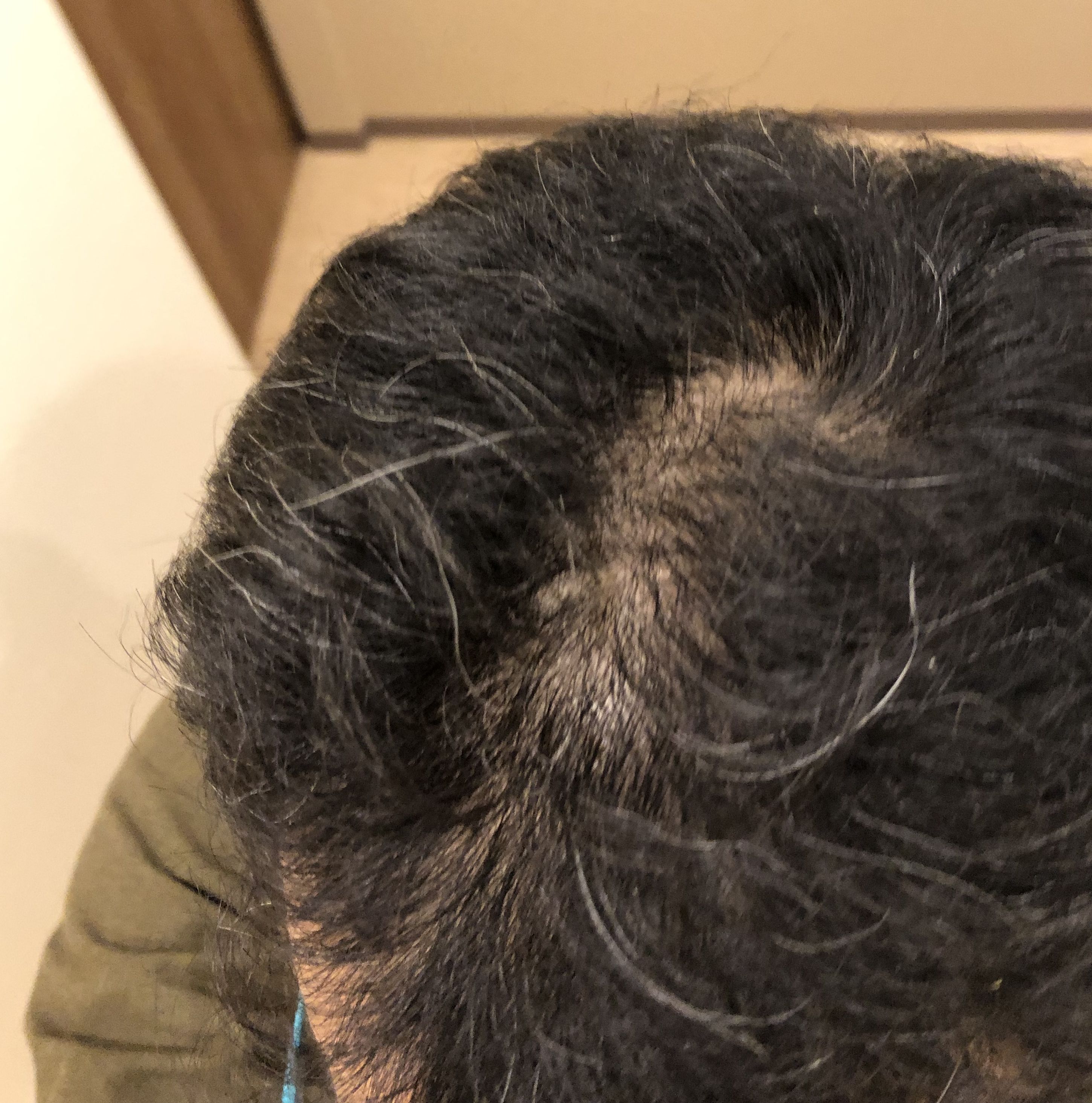 ハゲ、薄毛画像