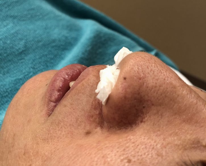 お灸する前の画像
鼻の頭にほくろがあります。